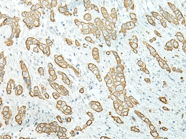 ETAA1 Antibody - Immunohistochemistry of paraffin-embedded Human breast cancer tissue  using ETAA1 Polyclonal Antibody at dilution of 1:40(×200)