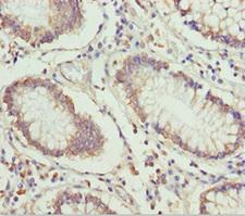 ETFA Antibody - Immunohistochemistry of paraffin-embedded human colon cancer at dilution 1:100