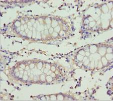 ETFA Antibody - Immunohistochemistry of paraffin-embedded human colon cancer at dilution 1:100
