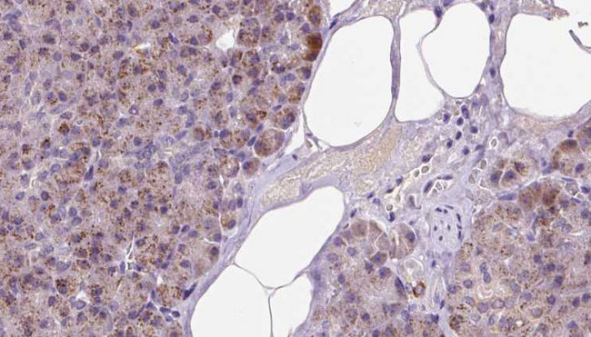 ETFA Antibody - 1:100 staining human pancreas carcinoma tissue by IHC-P. The sample was formaldehyde fixed and a heat mediated antigen retrieval step in citrate buffer was performed. The sample was then blocked and incubated with the antibody for 1.5 hours at 22°C. An HRP conjugated goat anti-rabbit antibody was used as the secondary.