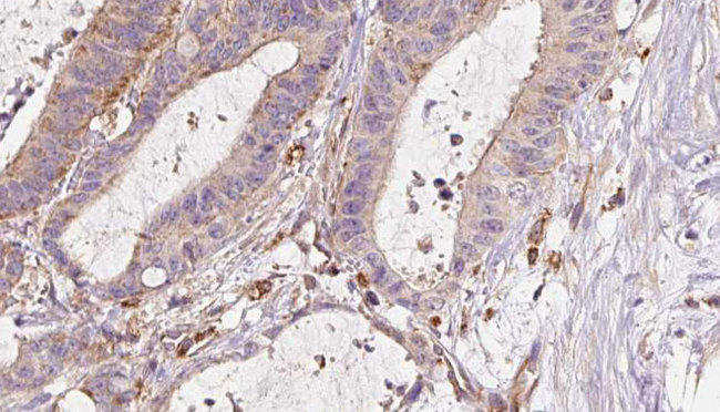 ETFB Antibody - 1:100 staining human liver carcinoma tissues by IHC-P. The sample was formaldehyde fixed and a heat mediated antigen retrieval step in citrate buffer was performed. The sample was then blocked and incubated with the antibody for 1.5 hours at 22°C. An HRP conjugated goat anti-rabbit antibody was used as the secondary.