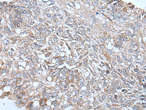 ETFB Antibody - Immunohistochemistry of paraffin-embedded Human lung cancer tissue  using ETFB Polyclonal Antibody at dilution of 1:40(×200)