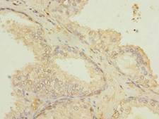 ETFDH Antibody - Immunohistochemistry of paraffin-embedded human prostate cancer using antibody at dilution of 1:100.