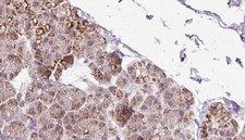 ETFDH Antibody - 1:100 staining human pancreas carcinoma tissue by IHC-P. The sample was formaldehyde fixed and a heat mediated antigen retrieval step in citrate buffer was performed. The sample was then blocked and incubated with the antibody for 1.5 hours at 22°C. An HRP conjugated goat anti-rabbit antibody was used as the secondary.