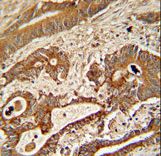ETHE1 Antibody - ETHE1 Antibody immunohistochemistry of formalin-fixed and paraffin-embedded human colon carcinoma followed by peroxidase-conjugated secondary antibody and DAB staining.