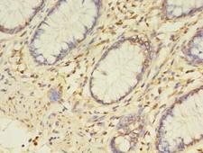 ETHE1 Antibody - Immunohistochemistry of paraffin-embedded human colon cancer using antibody at dilution of 1:100.
