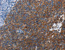 ETHE1 Antibody - Immunohistochemistry of paraffin-embedded Human cervical cancer using ETHE1 Polyclonal Antibody at dilution of 1:20.