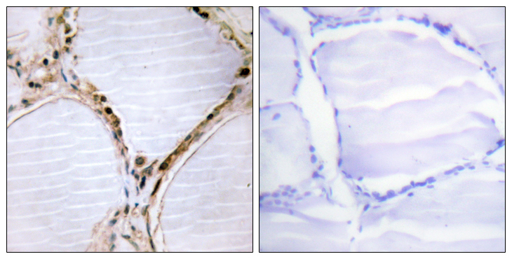 ETK / BMX Antibody - Immunohistochemistry analysis of paraffin-embedded human thyroid gland tissue, using ETK Antibody. The picture on the right is blocked with the synthesized peptide.