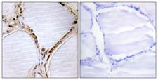ETK / BMX Antibody - Immunohistochemistry analysis of paraffin-embedded human thyroid gland tissue, using ETK Antibody. The picture on the right is blocked with the synthesized peptide.