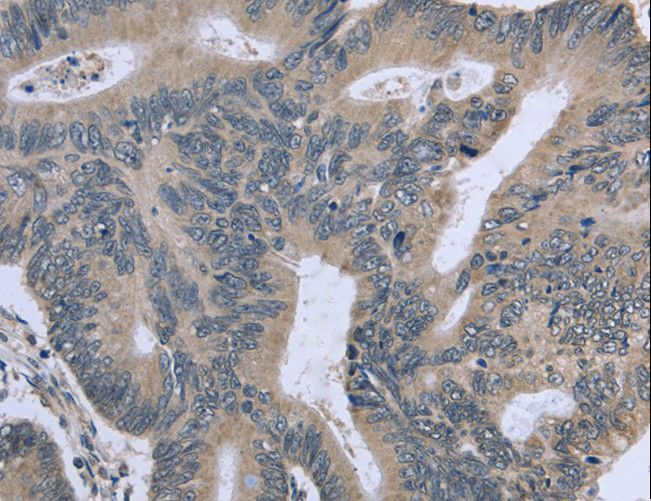 ETK / BMX Antibody - Immunohistochemistry of paraffin-embedded Human cervical cancer using BMX Polyclonal Antibody at dilution of 1:30.