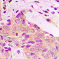 ETK / BMX Antibody - Immunohistochemical analysis of BMX staining in human breast cancer formalin fixed paraffin embedded tissue section. The section was pre-treated using heat mediated antigen retrieval with sodium citrate buffer (pH 6.0). The section was then incubated with the antibody at room temperature and detected using an HRP conjugated compact polymer system. DAB was used as the chromogen. The section was then counterstained with hematoxylin and mounted with DPX.