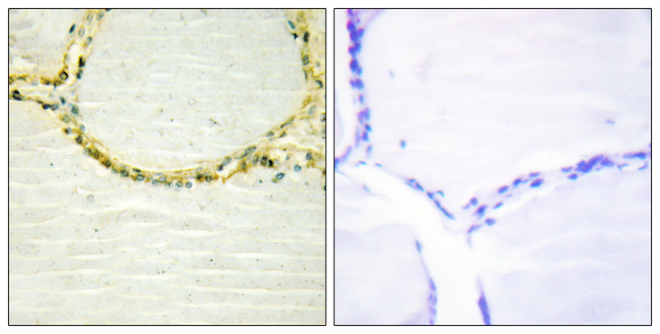 ETK / BMX Antibody - Immunohistochemistry analysis of paraffin-embedded human thyroid gland, using ETK (Phospho-Tyr566) Antibody. The picture on the right is blocked with the phospho peptide.