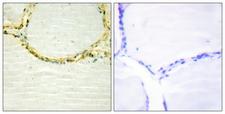 ETK / BMX Antibody - Immunohistochemistry analysis of paraffin-embedded human thyroid gland, using ETK (Phospho-Tyr566) Antibody. The picture on the right is blocked with the phospho peptide.