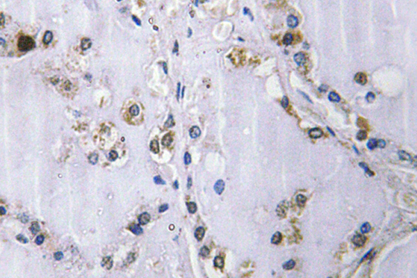 ETK / BMX Antibody - IHC of Bmx (Y43) pAb in paraffin-embedded human thyroid gland tissue.