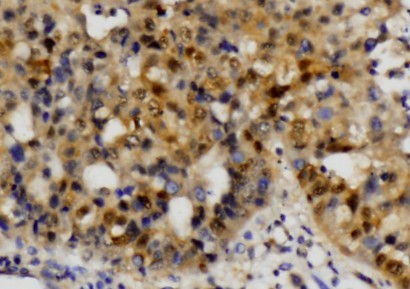 ETS1 / ETS-1 Antibody - IHC of ETS1 (A32) pAb in paraffin-embedded human hepatic carcinoma tissue.