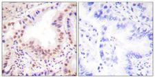 ETS1 / ETS-1 Antibody - Peptide - + Immunohistochemistry analysis of paraffin-embedded human lung carcinoma tissue using ETS1 (Ab-38) antibody.