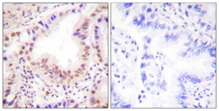 ETS1 / ETS-1 Antibody - Peptide - + Immunohistochemistry analysis of paraffin-embedded human lung carcinoma tissue using ETS1 (Ab-38) antibody.
