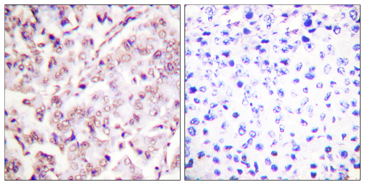 ETS1 / ETS-1 Antibody - Immunohistochemistry analysis of paraffin-embedded human breast carcinoma, using ETS1 (Phospho-Thr38) Antibody. The picture on the right is blocked with the phospho peptide.