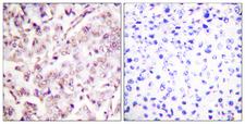 ETS1 / ETS-1 Antibody - P-peptide - + Immunohistochemistry analysis of paraffin-embedded human breast carcinoma tissue using ETS1 (Phospho-Thr38) antibody.