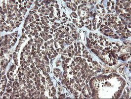 ETS2 Antibody - IHC of paraffin-embedded Carcinoma of Human thyroid tissue using anti-ETS2 mouse monoclonal antibody.