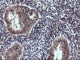 ETS2 Antibody - IHC of paraffin-embedded Adenocarcinoma of Human endometrium tissue using anti-ETS2 mouse monoclonal antibody.