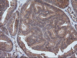 ETS2 Antibody - IHC of paraffin-embedded Carcinoma of Human thyroid tissue using anti-ETS2 mouse monoclonal antibody.