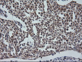 ETS2 Antibody - IHC of paraffin-embedded Carcinoma of Human bladder tissue using anti-ETS2 mouse monoclonal antibody.