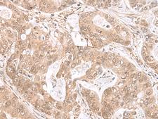 ETV3 Antibody - Immunohistochemistry of paraffin-embedded Human gastric cancer tissue  using ETV3 Polyclonal Antibody at dilution of 1:25(×200)