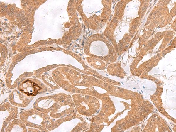 ETV3 Antibody - Immunohistochemistry of paraffin-embedded Human thyroid cancer tissue  using ETV3 Polyclonal Antibody at dilution of 1:25(×200)