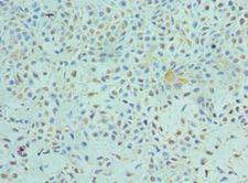 ETV6 / TEL Antibody - Immunohistochemistry of paraffin-embedded human breast cancer using antibody at 1:100 dilution.