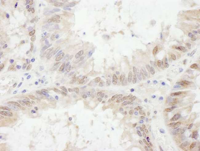 ETV6 / TEL Antibody - Detection of Human ETV6 by Immunohistochemistry. Sample: FFPE section of human colon carcinoma. Antibody: Affinity purified rabbit anti-ETV6 used at a dilution of 1:1000 (1 ug/ml). Detection: DAB.