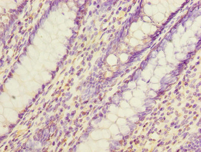 EVA1C Antibody - Immunohistochemistry of paraffin-embedded human colon cancer using EVA1C Antibody at dilution of 1:100