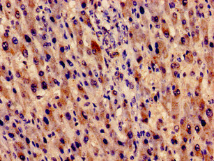 EVC / DWF-1 Antibody - Immunocytochemistry analysis of human liver cancer at a dilution of 1:100