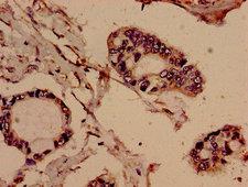 EVC / DWF-1 Antibody - Immunohistochemistry analysis of human pancreatic cancer at a dilution of 1:100