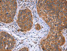 EVC2 Antibody - Immunohistochemistry of paraffin-embedded Human liver cancer using EVC2 Polyclonal Antibody at dilution of 1:40.