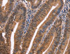 EVC2 Antibody - Immunohistochemistry of paraffin-embedded Human colon cancer using EVC2 Polyclonal Antibody at dilution of 1:40.