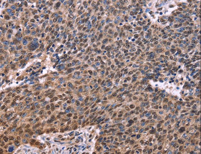 EVC2 Antibody - Immunohistochemistry of paraffin-embedded Human ovarian cancer using EVC2 Polyclonal Antibody at dilution of 1:40.