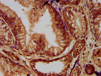 EVC2 Antibody - Immunohistochemistry Dilution at 1:200 and staining in paraffin-embedded human prostate cancer performed on a Leica BondTM system. After dewaxing and hydration, antigen retrieval was mediated by high pressure in a citrate buffer (pH 6.0). Section was blocked with 10% normal Goat serum 30min at RT. Then primary antibody (1% BSA) was incubated at 4°C overnight. The primary is detected by a biotinylated Secondary antibody and visualized using an HRP conjugated SP system.