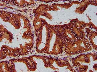 EVC2 Antibody - Immunohistochemistry Dilution at 1:200 and staining in paraffin-embedded human prostate tissue performed on a Leica BondTM system. After dewaxing and hydration, antigen retrieval was mediated by high pressure in a citrate buffer (pH 6.0). Section was blocked with 10% normal Goat serum 30min at RT. Then primary antibody (1% BSA) was incubated at 4°C overnight. The primary is detected by a biotinylated Secondary antibody and visualized using an HRP conjugated SP system.