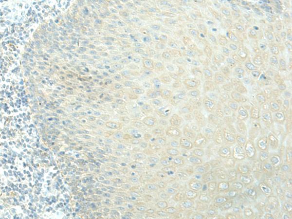 EVI2B Antibody - Immunohistochemistry of paraffin-embedded Human esophagus cancer tissue  using EVI2B Polyclonal Antibody at dilution of 1:40(×200)