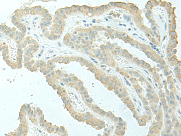 EVI2B Antibody - Immunohistochemistry of paraffin-embedded Human thyroid cancer tissue  using EVI2B Polyclonal Antibody at dilution of 1:40(×200)