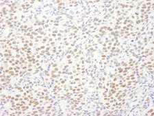 EWSR1 / EWS Antibody - Detection of Human EWS by Immunohistochemistry. Sample: FFPE section of human breast carcinoma. Antibody: Affinity purified rabbit anti-EWS used at a dilution of 1:1000 (1 Detection: DAB.