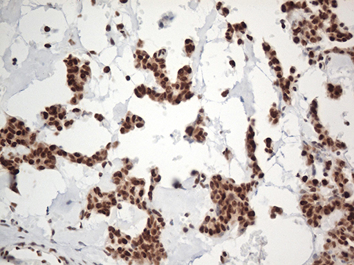 EWSR1 / EWS Antibody - Immunohistochemical staining of paraffin-embedded Carcinoma of Human pancreas tissue using anti-EWSR1 mouse monoclonal antibody. (Heat-induced epitope retrieval by 1mM EDTA in 10mM Tris buffer. (pH8.5) at 120°C for 3 min. (1:500)