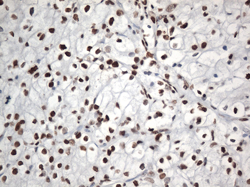 EWSR1 / EWS Antibody - Immunohistochemical staining of paraffin-embedded Carcinoma of Human kidney tissue using anti-EWSR1 mouse monoclonal antibody. (Heat-induced epitope retrieval by 1mM EDTA in 10mM Tris buffer. (pH8.5) at 120°C for 3 min. (1:500)