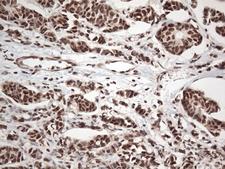 EWSR1 / EWS Antibody - Immunohistochemical staining of paraffin-embedded Adenocarcinoma of Human breast tissue tissue using anti-EWSR1 mouse monoclonal antibody. (Heat-induced epitope retrieval by 1mM EDTA in 10mM Tris buffer. (pH8.5) at 120°C for 3 min. (1:500)