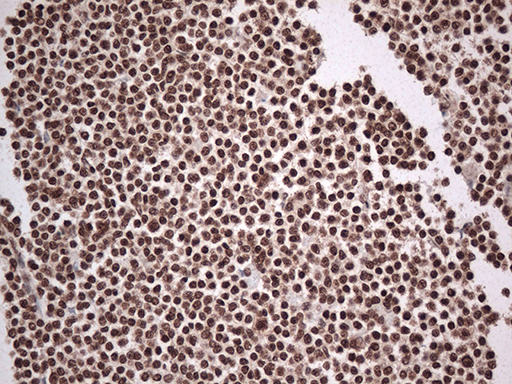 EWSR1 / EWS Antibody - Immunohistochemical staining of paraffin-embedded Human lymphoma tissue using anti-EWSR1 mouse monoclonal antibody. (Heat-induced epitope retrieval by 1mM EDTA in 10mM Tris buffer. (pH8.5) at 120°C for 3 min. (1:500)