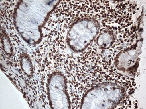 EWSR1 / EWS Antibody - Immunohistochemical staining of paraffin-embedded Adenocarcinoma of Human colon tissue using anti-EWSR1 mouse monoclonal antibody. (Heat-induced epitope retrieval by 1mM EDTA in 10mM Tris buffer. (pH8.5) at 120°C for 3 min. (1:500)