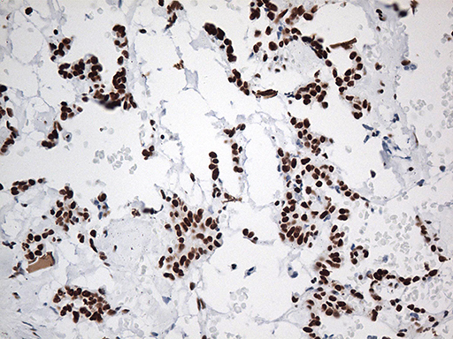 EWSR1 / EWS Antibody - Immunohistochemical staining of paraffin-embedded Carcinoma of Human pancreas tissue using anti-EWSR1 mouse monoclonal antibody. (Heat-induced epitope retrieval by 1mM EDTA in 10mM Tris buffer. (pH8.5) at 120°C for 3 min. (1:500)