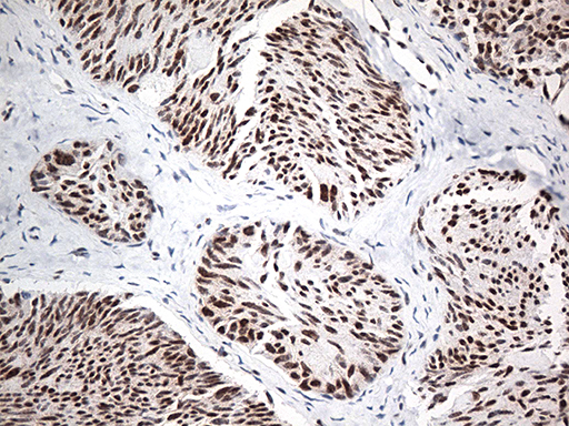 EWSR1 / EWS Antibody - Immunohistochemical staining of paraffin-embedded Carcinoma of Human thyroid tissue using anti-EWSR1 mouse monoclonal antibody. (Heat-induced epitope retrieval by 1mM EDTA in 10mM Tris buffer. (pH8.5) at 120°C for 3 min. (1:500)