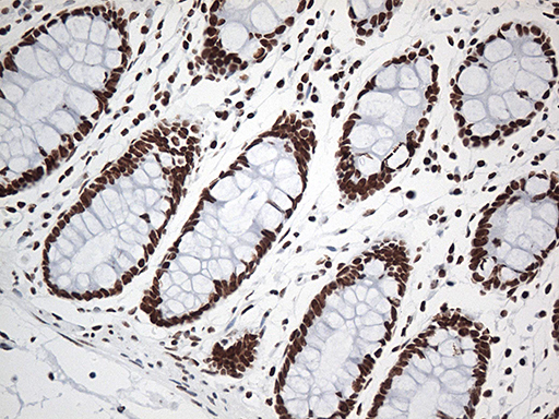 EWSR1 / EWS Antibody - Immunohistochemical staining of paraffin-embedded Human colon tissue within the normal limits using anti-EWSR1 mouse monoclonal antibody. (Heat-induced epitope retrieval by 1mM EDTA in 10mM Tris buffer. (pH8.5) at 120°C for 3 min. (1:500)